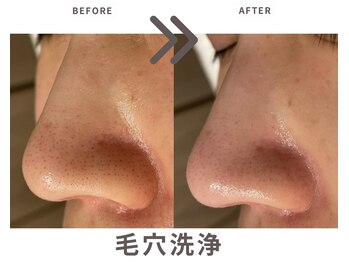 エステティックサロン ラ ベルタ(Esthetic Salon La Belta)/毛穴洗浄
