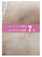 エアリアル 八代店/両ワキ美肌脱毛♪毛穴までキレイ