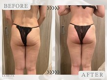 エステティックサロン ラ ベルタ(Esthetic Salon La Belta)/レモンボトル+セルライトゼロ3回