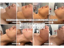 ハーブピーリング/マイクロウェーブ/韓国肌管理