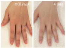 キレイテ 福岡天神店/40代/4回目【博多ハンドケア】