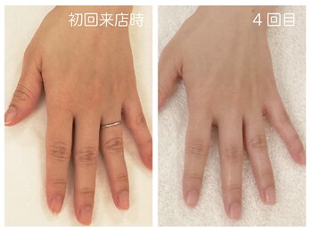 キレイテ 福岡天神店/40代/4回目【博多ハンドケア】