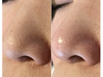 ルアナ(Luana)/最短で綺麗になる毛穴ケア