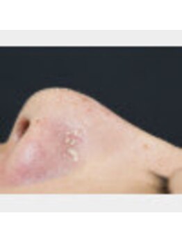 グルステ 吉祥寺店/毛穴洗浄&小顔矯正ならグルステ