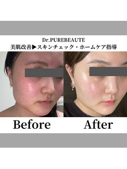 インフィニーズ(INFINEEZ)/ピュールボーテ肌改善ホームケア