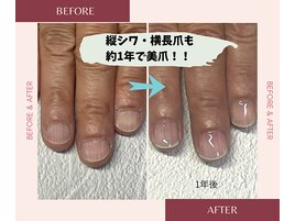 縦シワ丸い爪も大変身