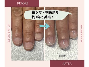 ブルームブルーム(BLOOMブルーム)/縦シワ丸い爪も大変身