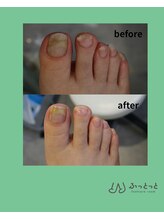 ふっとっと/爪ケア　before　after