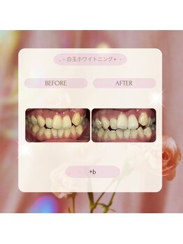 プラスビー 2号店(+b)/ホワイトニングビフォーアフター