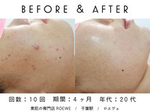 ロエヴェ(ROEWE)/ニキビ改善・毛穴ケア・肌質改善
