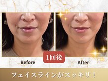 ビーシャルム(b.ChaRme)/美肌×たるみを同時にアプローチ