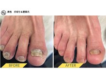 ふっとけ庵/肥厚爪ケア