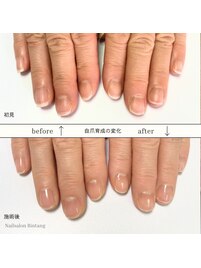 二枚爪や、割れやすい爪のお悩み