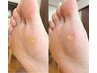 90分【魚の目・タコ】気になる足裏を定期ケア