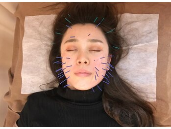 こじま 富雄団地接骨院/むくみケア☆美容鍼