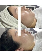 レイ(Rey)/小顔と艶肌が叶うセットメニュー