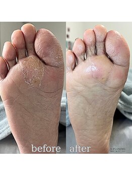 フットミー(foot mii)/