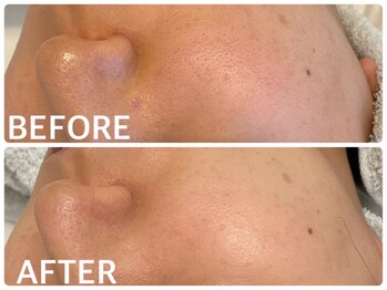 ハーブピーリング 心斎橋/ハーブピーリングで毛穴ケア