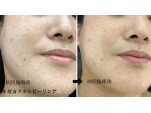 メディカルサロンドオフ 堺東店(medical salon de off)/LEZE(ルゼ)カクテルピーリング