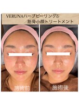 ココ 2号店(CoCo)/ハーブピーリング&美禅筋骨小顔