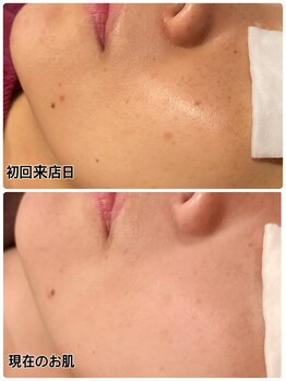 レイール(Reir)/フォト美顔