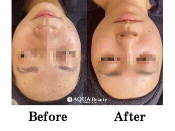 ビーエスアクアビューティー/ハイドラ＋ハーバルピーリング