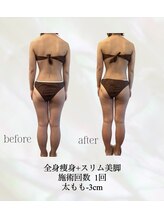 カリス(charis)/全身痩身　初回体験