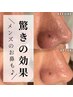 メンズ：大人気”毛穴つるん”毛穴の悩みに！ハイドラ毛穴洗浄　全顔￥5980