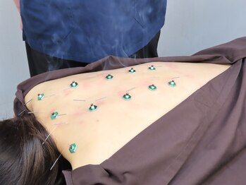 西小山弁天通り 鍼灸治療院/冷えやすい季節に鍼灸×整体