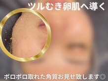 グレース 吉祥寺(grace)/毛穴・角栓 除去【吉祥寺】