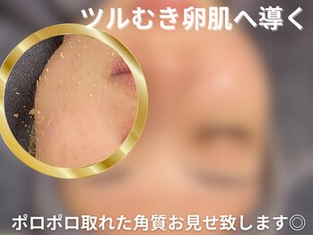 グレース 吉祥寺(grace)/毛穴・角栓 除去【吉祥寺】