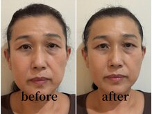 たたら鍼灸整骨院/50代女性　before / after