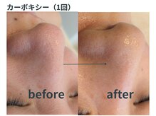 ミジタク 京都二条店(mijitaku)/カーボキシー1回のお肌