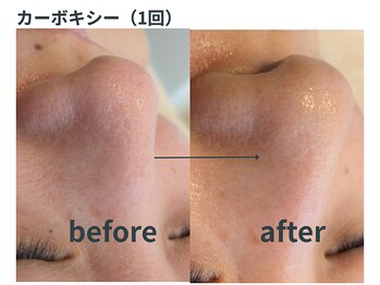ミジタク 京都二条店(mijitaku)/カーボキシー1回のお肌