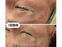 エクソソームがすごい♪深いシワ、シミケアくすみ乾燥に！