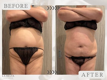 エステティックサロン ラ ベルタ(Esthetic Salon La Belta)/美骨ケア+セルライトゼロ3回