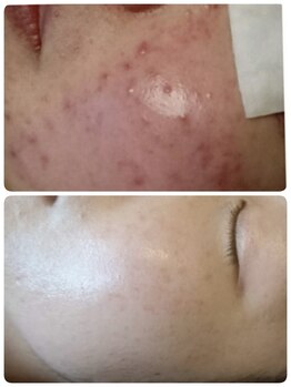 ソリッジ肌管理室/毛穴、ニキビケア、赤ら顔