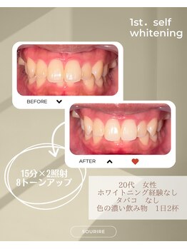 スリール(sourire)/ホワイトニング