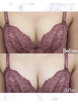 リュール(Lueur)/バストアップ症例写真