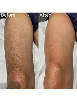 ア レーズ(a laise)/メンズVIO脱毛☆