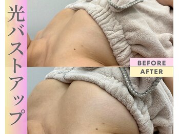Cスキンケアクリニック 麻布店/光バストアップBeforeAfter