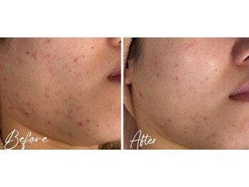 お顔そりローズマリー/ハーブピーリング