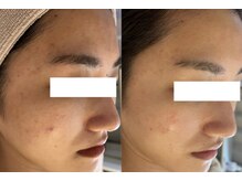 ラポール 野並SC店(Rapport)/ニキビ・肌荒れ跡ケア(23歳)