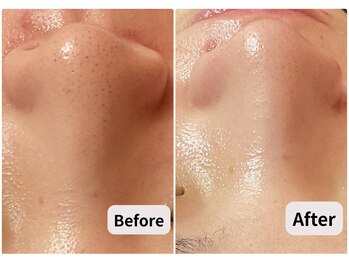 ブプラ 池田店(BUPURA)/毛穴汚れ　黒ずみ　毛穴詰まり