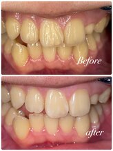 ビューティーケア(beauty care)/【ホワイトニング】