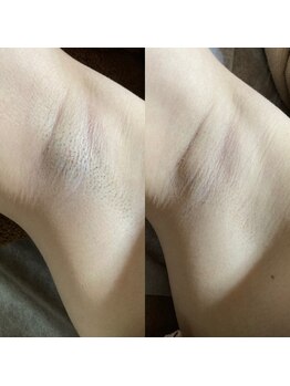 リラチル(relachill)/脇脱毛