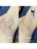 剃ってもすぐに伸びる方！黒ずみ・ザラザラを卒業◎  両ワキ 光脱毛　￥2,200