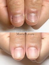 マリーロール 淀屋橋本店(Marie Laure)/自爪育成/深爪矯正/ネイルケア