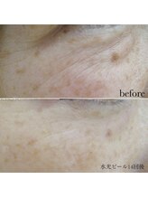 メゾリーナ(MAISOReNA)/水光ピーリング