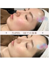 ビューティーモア(more)/最先端毛穴つるりんフェイシャル